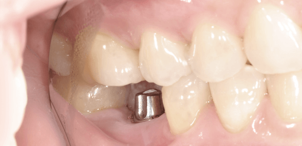 Implants Teeth