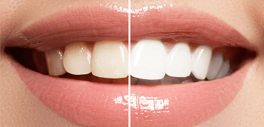 Before-and-after-Cosmetic-Dental