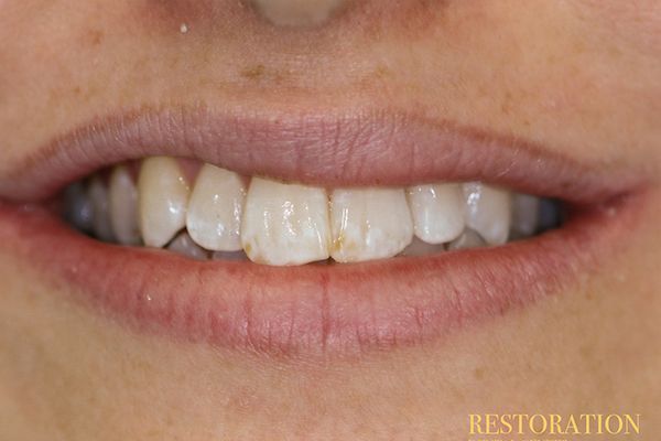 A close up of a person 's mouth showing their teeth.