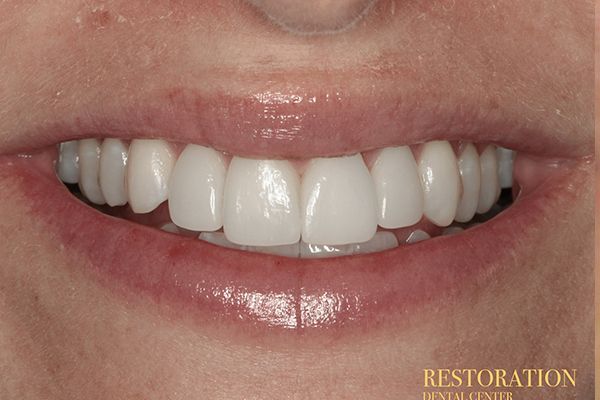 A close up of a woman 's smile with white teeth.