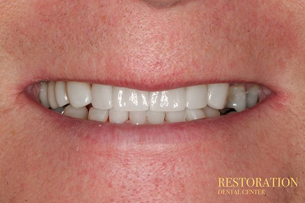 A close up of a person 's mouth with white teeth.