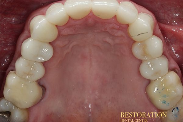 A close up of a person 's mouth with white teeth.