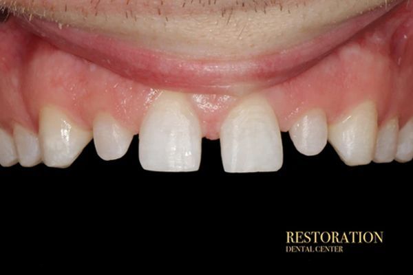 A close up of a man 's teeth with a missing tooth.