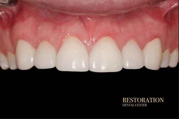 A close up of a person 's teeth with restoration dental center written on the bottom