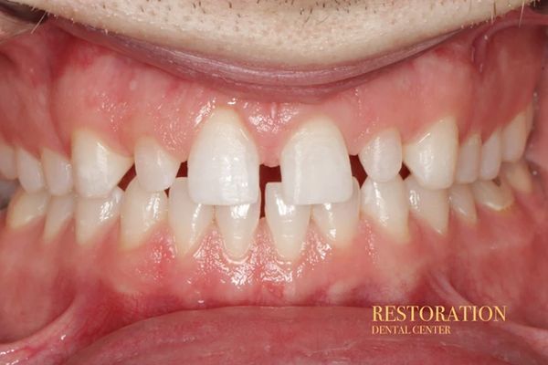 A close up of a person 's teeth with a missing tooth.