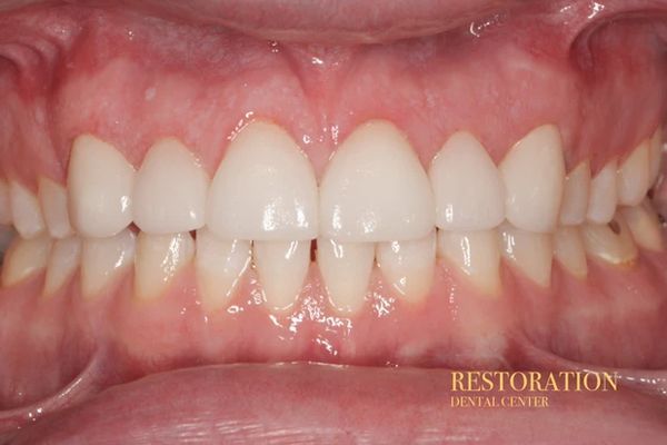 A close up of a person 's teeth with white teeth.