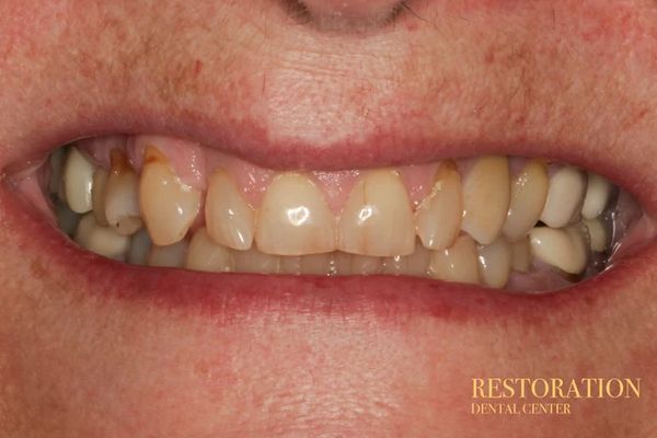 A close up of a person 's teeth with a restoration dental center logo in the corner.