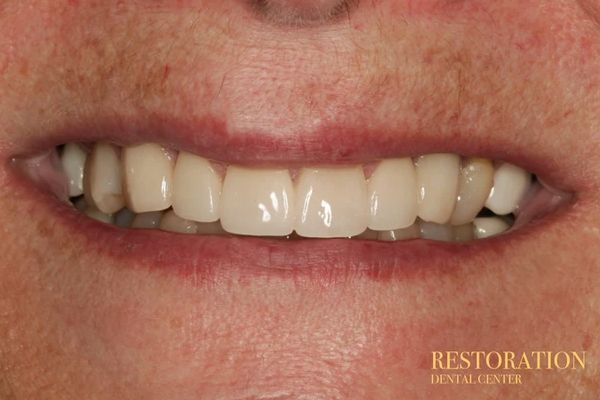 A close up of a person 's mouth with white teeth.