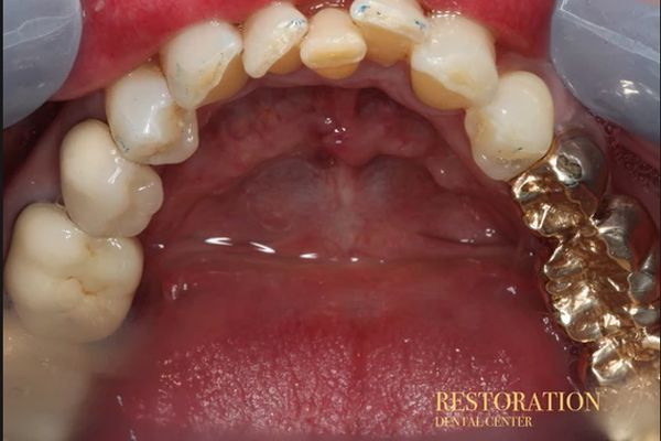 A close up of a person 's teeth with restoration dental center written on the bottom