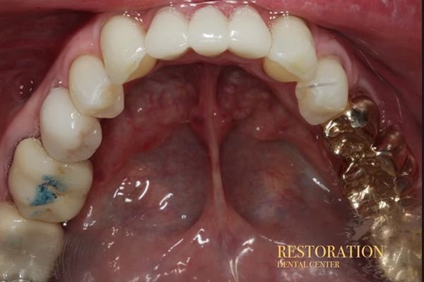 A close up of a person 's teeth with the words restoration dental center on the bottom