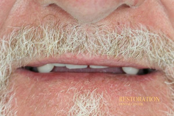 A close up of an older man 's mouth with a beard.