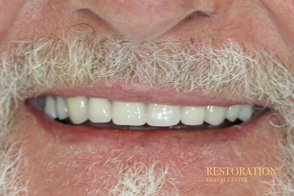 A close up of a man 's mouth with a beard and white teeth.