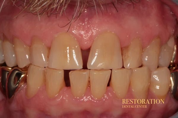 A close up of a person 's teeth with gold braces.