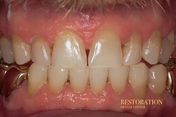 A close up of a person 's teeth with a gold brace.