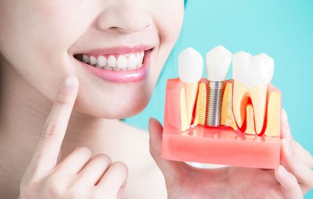 A woman is holding a model of a dental implant.