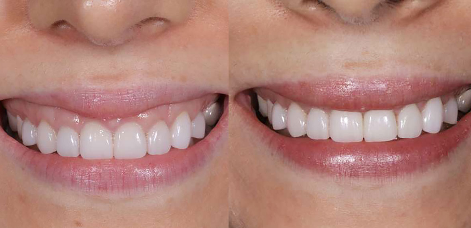 A before and after picture of a woman's gum and teeth.