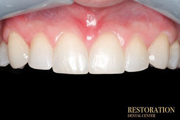 A close up of a person 's teeth with a black background.