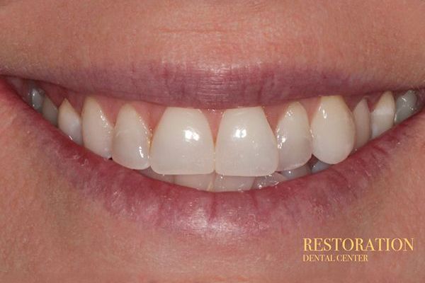 A close up of a woman 's smile with white teeth.