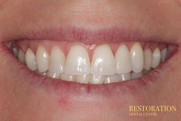 A close up of a woman 's smile with white teeth.