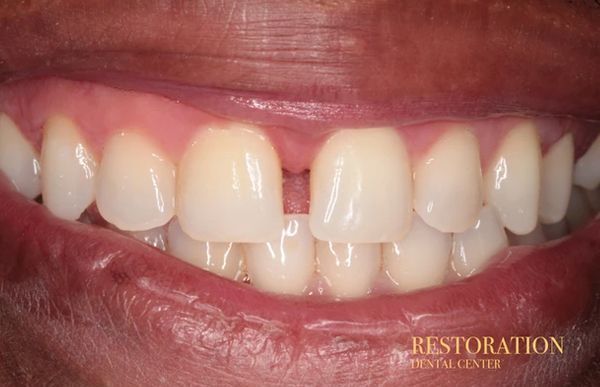 A close up of a person 's teeth with a missing tooth.