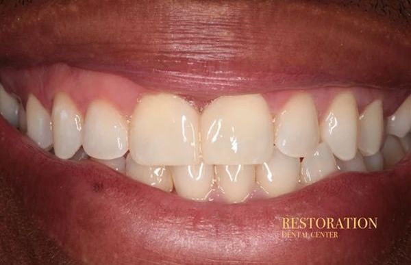 A close up of a person 's mouth with white teeth.