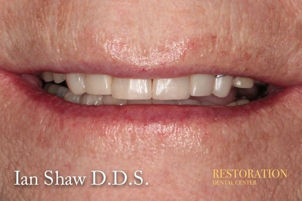 A close up of a person 's teeth with the name ian shaw d.d.s. on the bottom