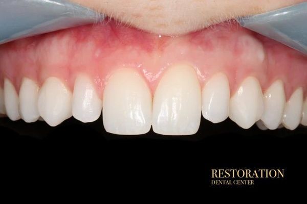 A close up of a person 's teeth with a dental mirror.