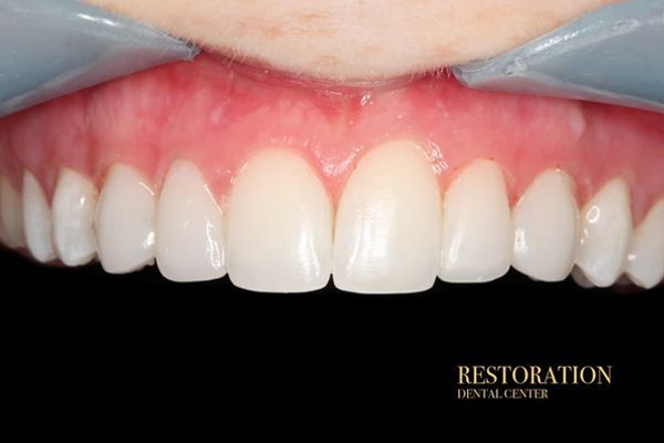 A close up of a person 's teeth with a black background.