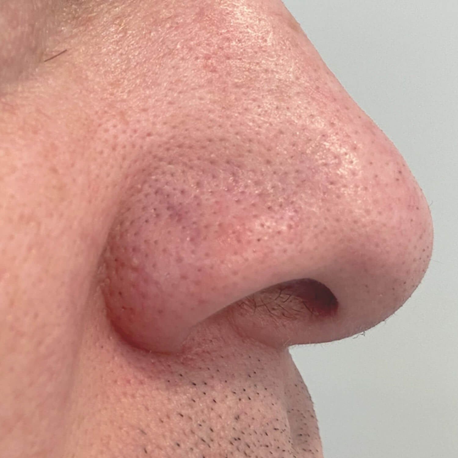 A close-up of a person's nose and cheek, showing visible pores and skin texture.