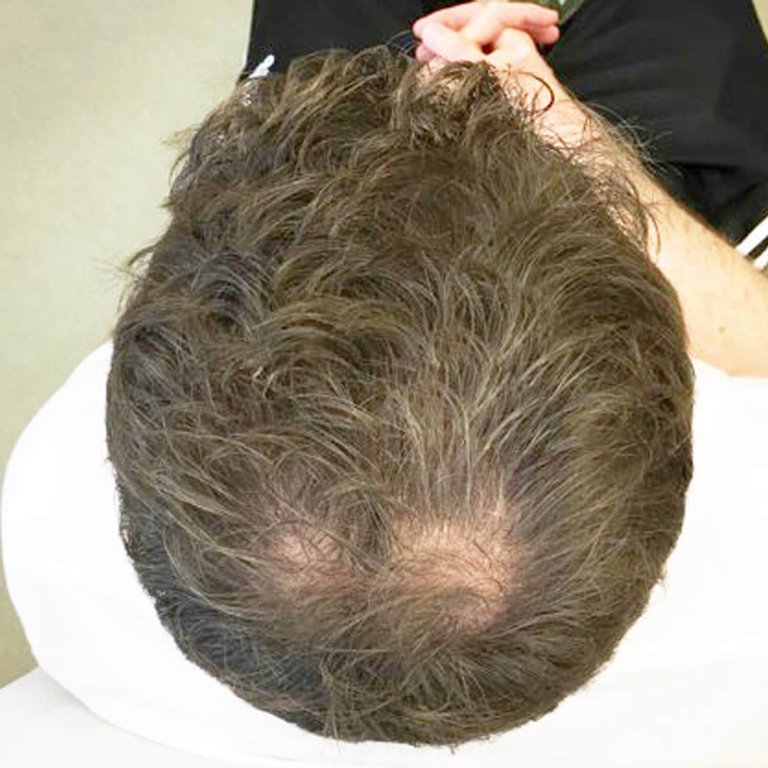 Top-down view of a person's head showing thinning hair and visible scalp at the crown.