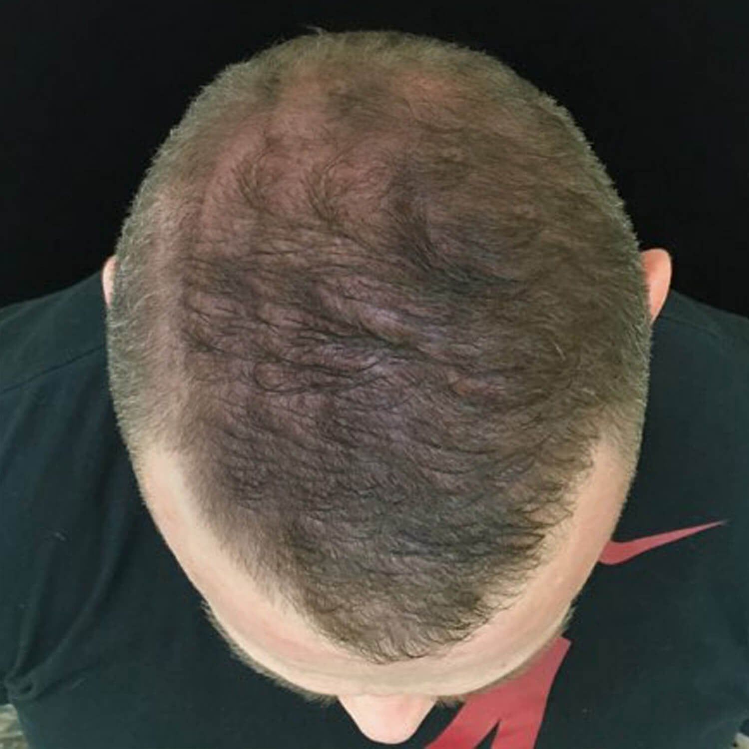 A top-down view of a person’s thinning hair, showing a receding hairline and reduced density across the scalp.