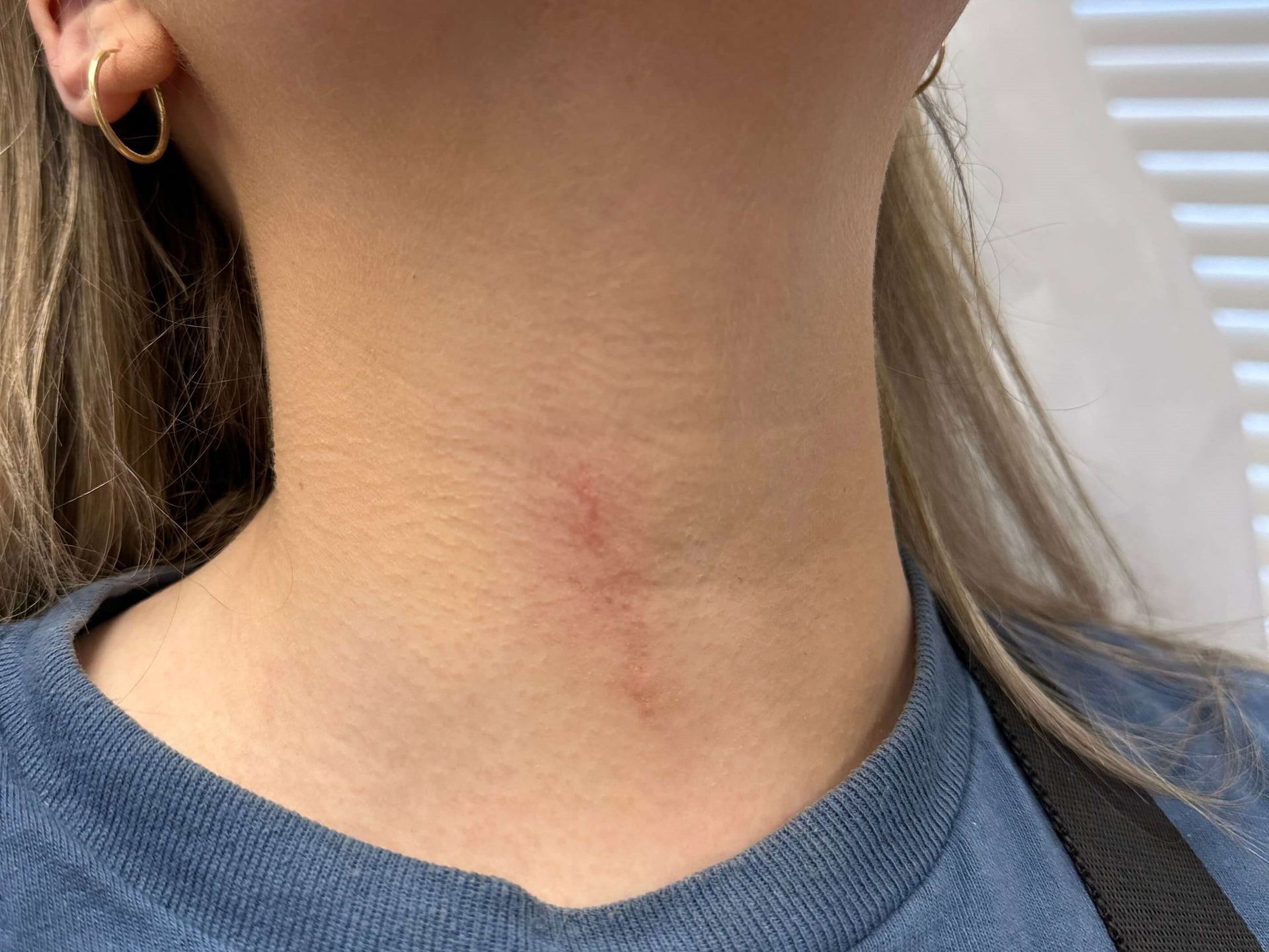 Close-up of a person's neck showing a faint, vertical, slightly pinkish scar on the front of the throat.