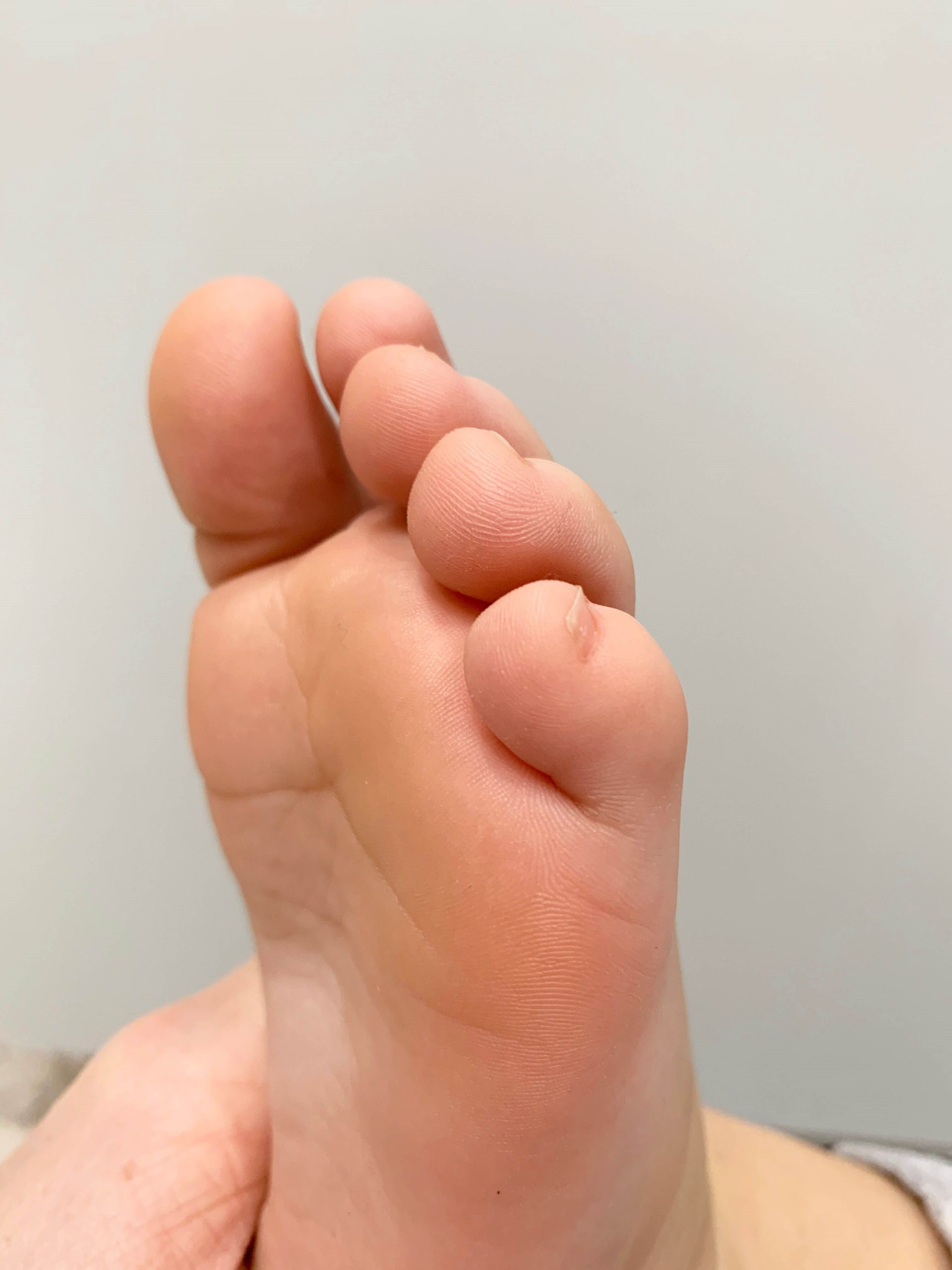 A human foot showing a small, raised, pale skin lesion on the pad of the second toe.