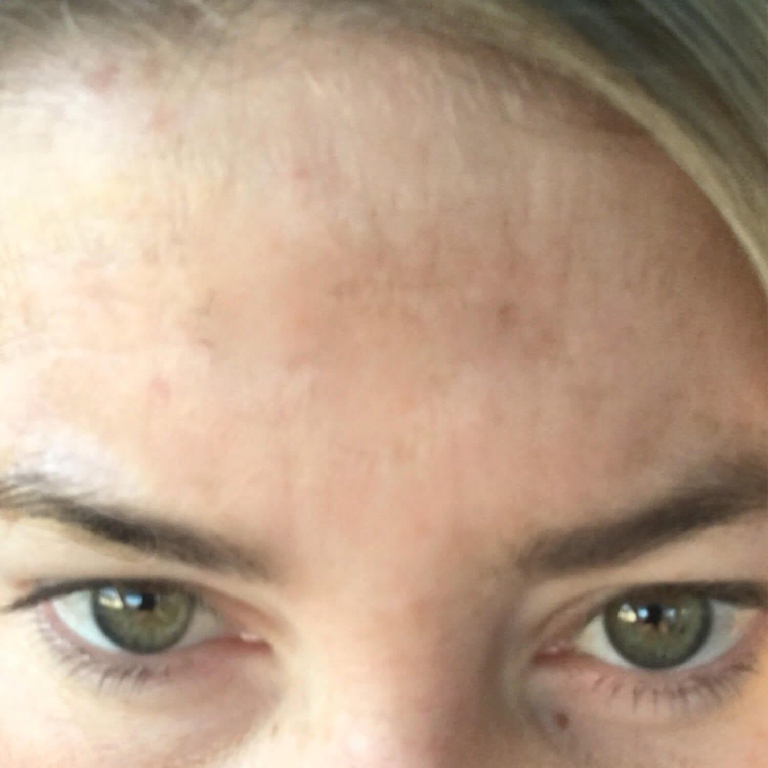 Close-up of a person's forehead showing uneven skin tone, visible texture, and small spots.