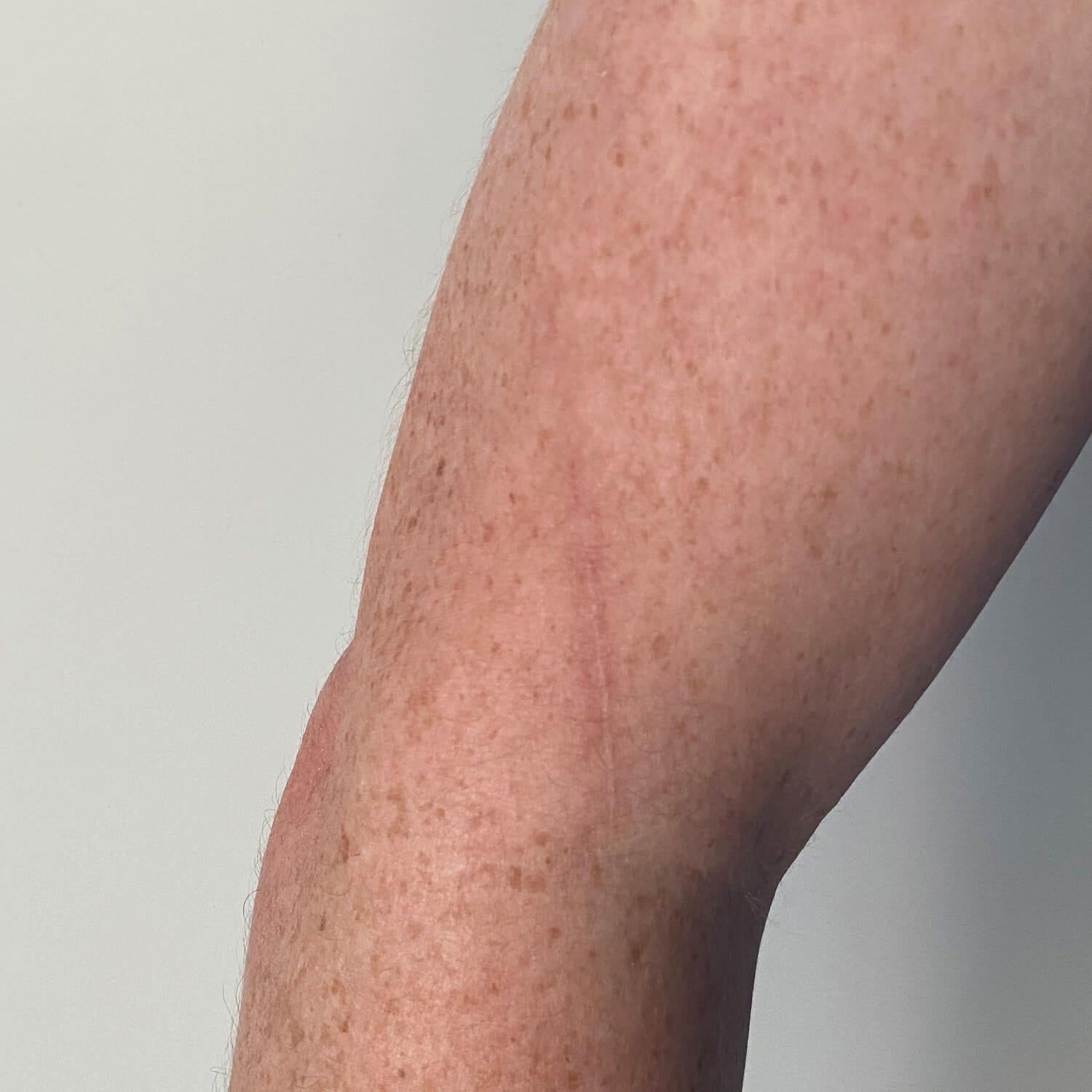 A close-up view of a person's upper arm, showing numerous small freckles and a faint, thin vertical scar on the skin.