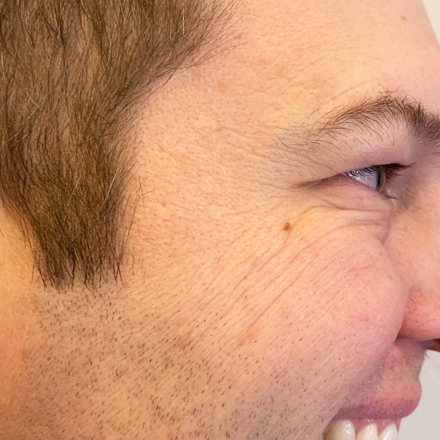 A close-up view of a person's temple and eye area, showing fine lines near the outer corner of the eye.