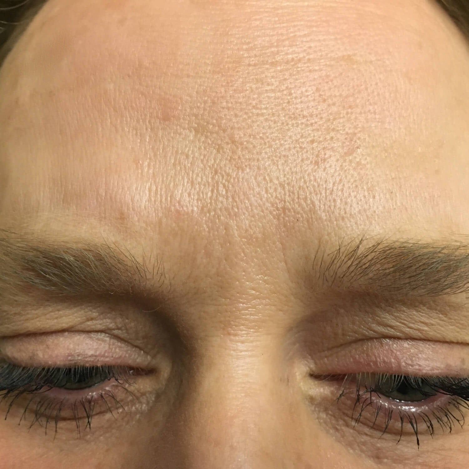 A close-up view of a person's upper face, focusing on the forehead and the area around the eyes.
