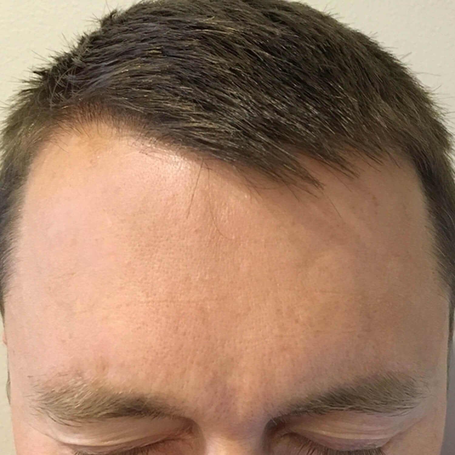 Close-up of a person's forehead, hairline, and eyebrows against a plain background.