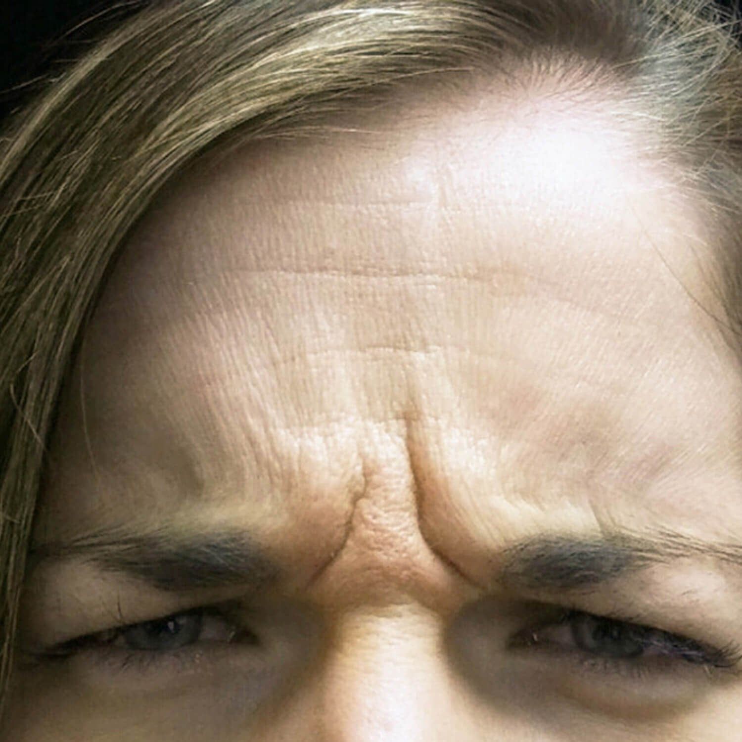 Close-up of a person's forehead and eyes, showing a furrowed brow with prominent wrinkles in an expression of concern.