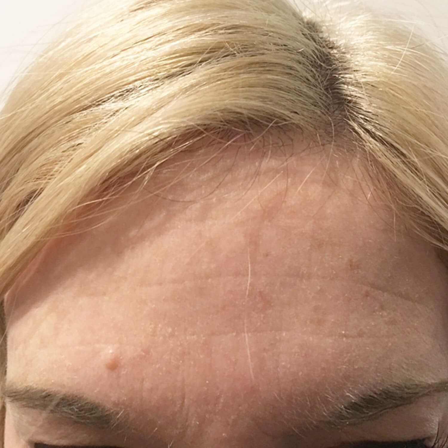 Close-up of a forehead showing dry, textured skin, fine lines, and a small, raised spot above the left eyebrow.