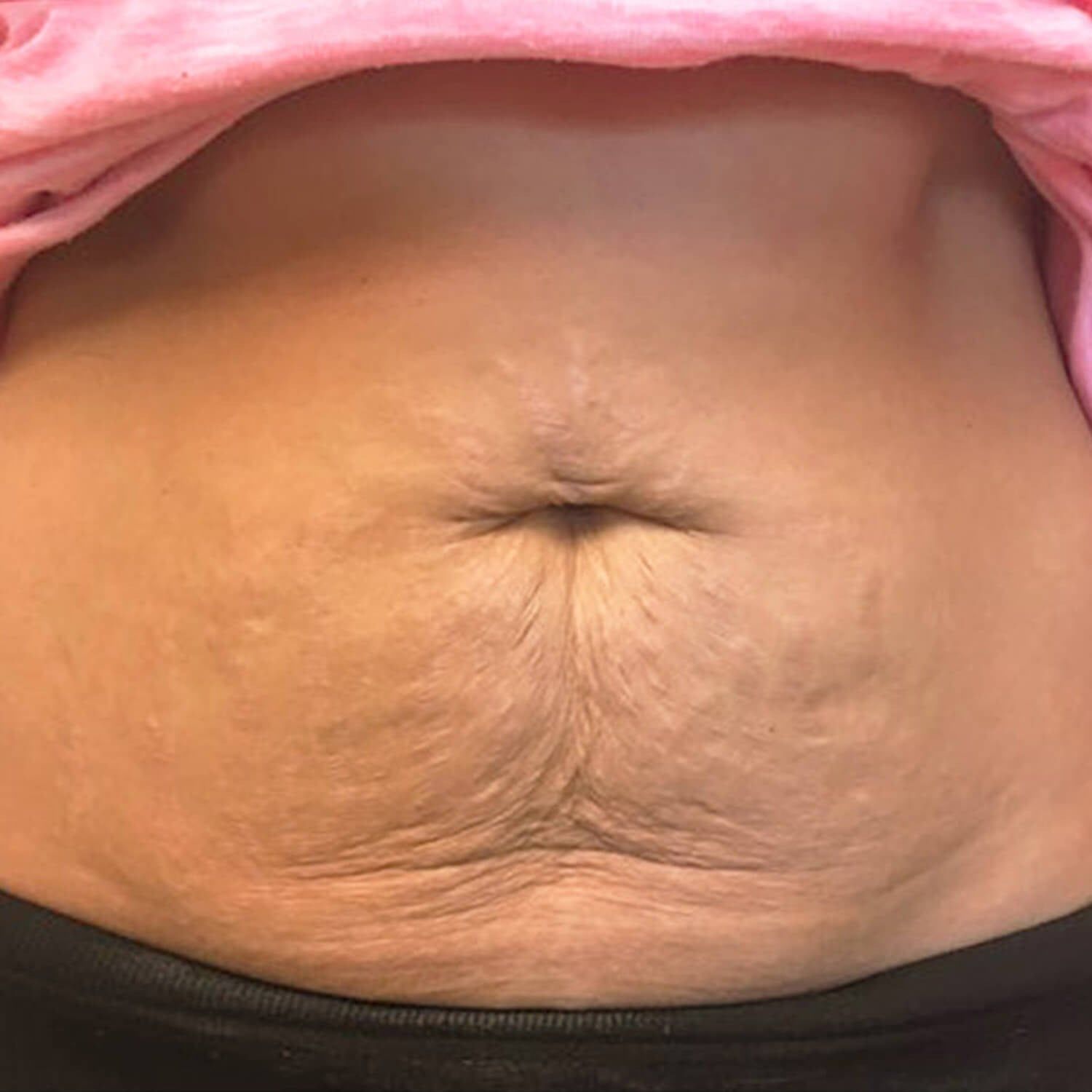 Close-up of an abdomen showing skin laxity and stretch marks around the navel area.