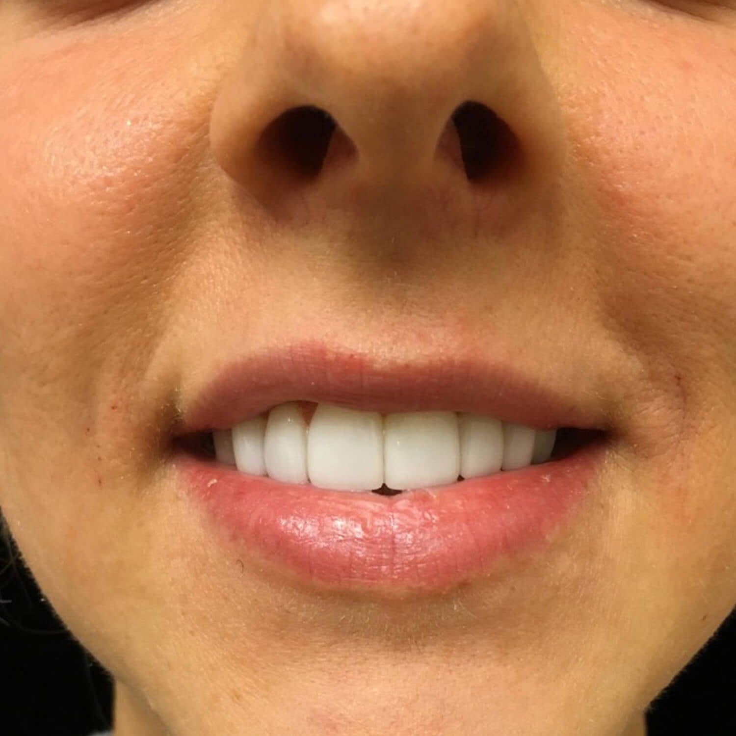 A close-up view of a smiling mouth showcasing bright white, well-aligned teeth and natural-looking gums.
