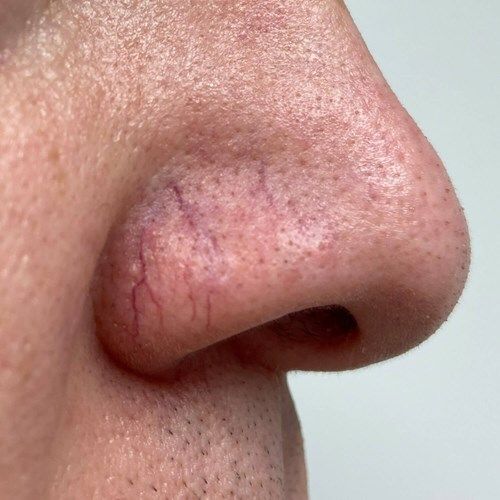 Close-up of a human nose showing visible, thin red and purple spider veins on the bridge and nostril area.