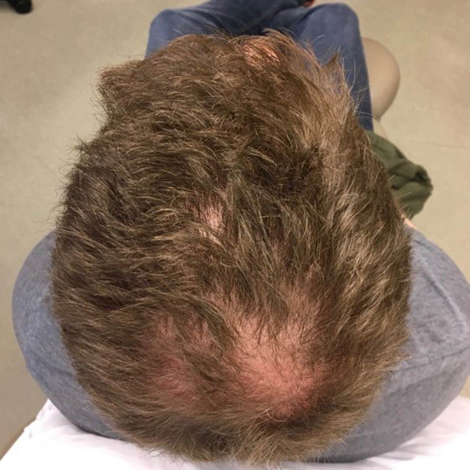 A top-down view showing a person's head with noticeable thinning hair and scalp visibility at the crown.