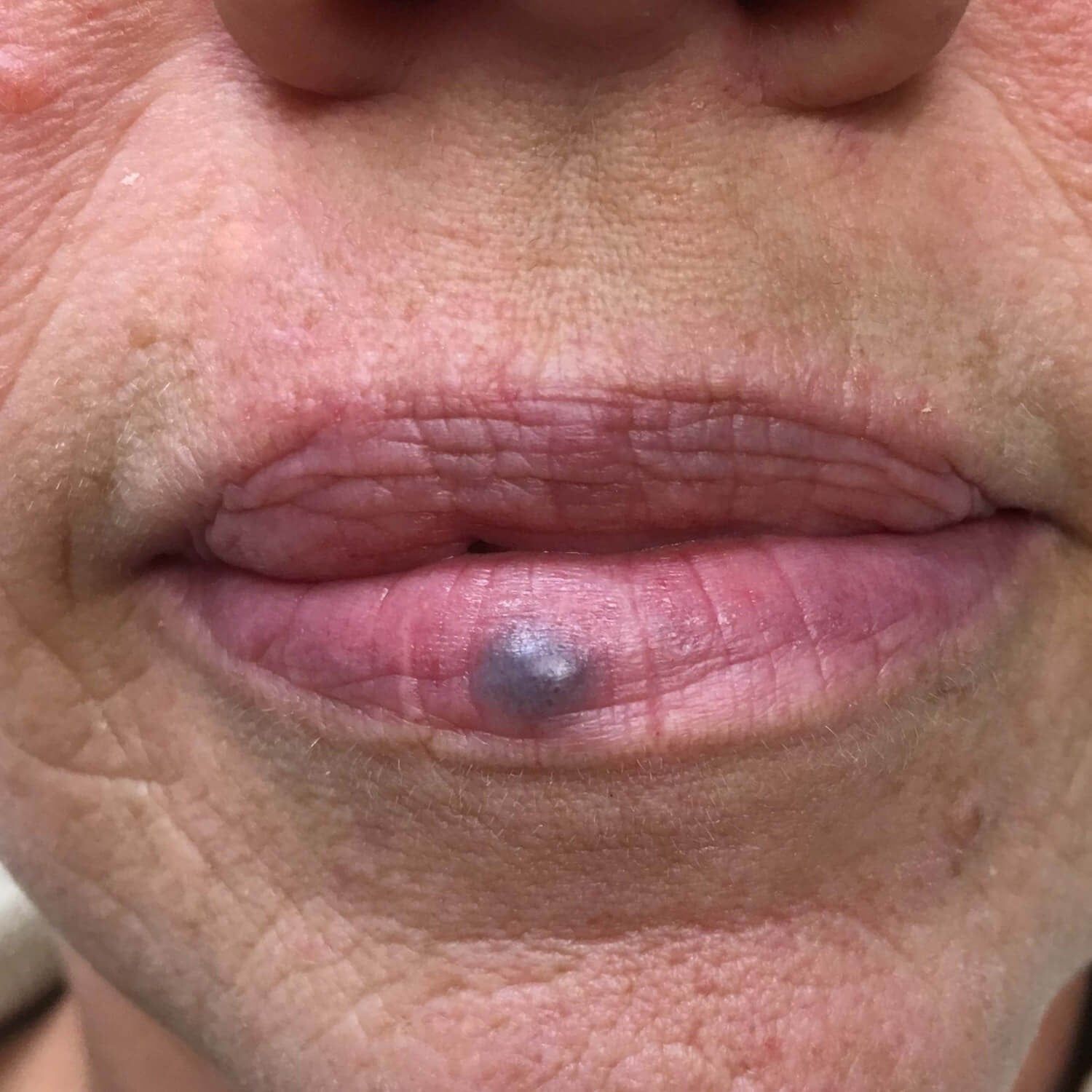 Close-up of a lower lip with a small, raised, circular, blue-purple lesion on the mucosal surface.