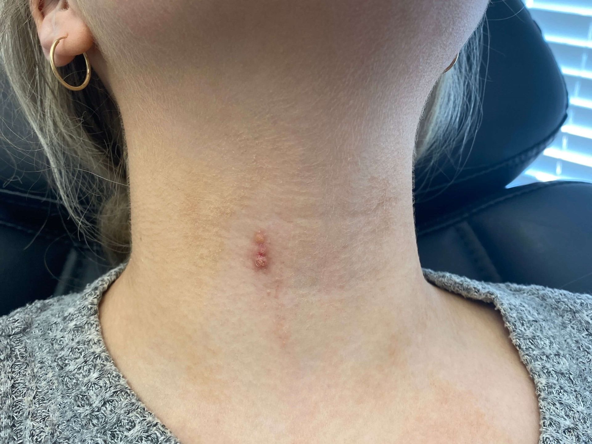 Close-up of a person's neck showing a small, slightly raised, reddish skin lesion.