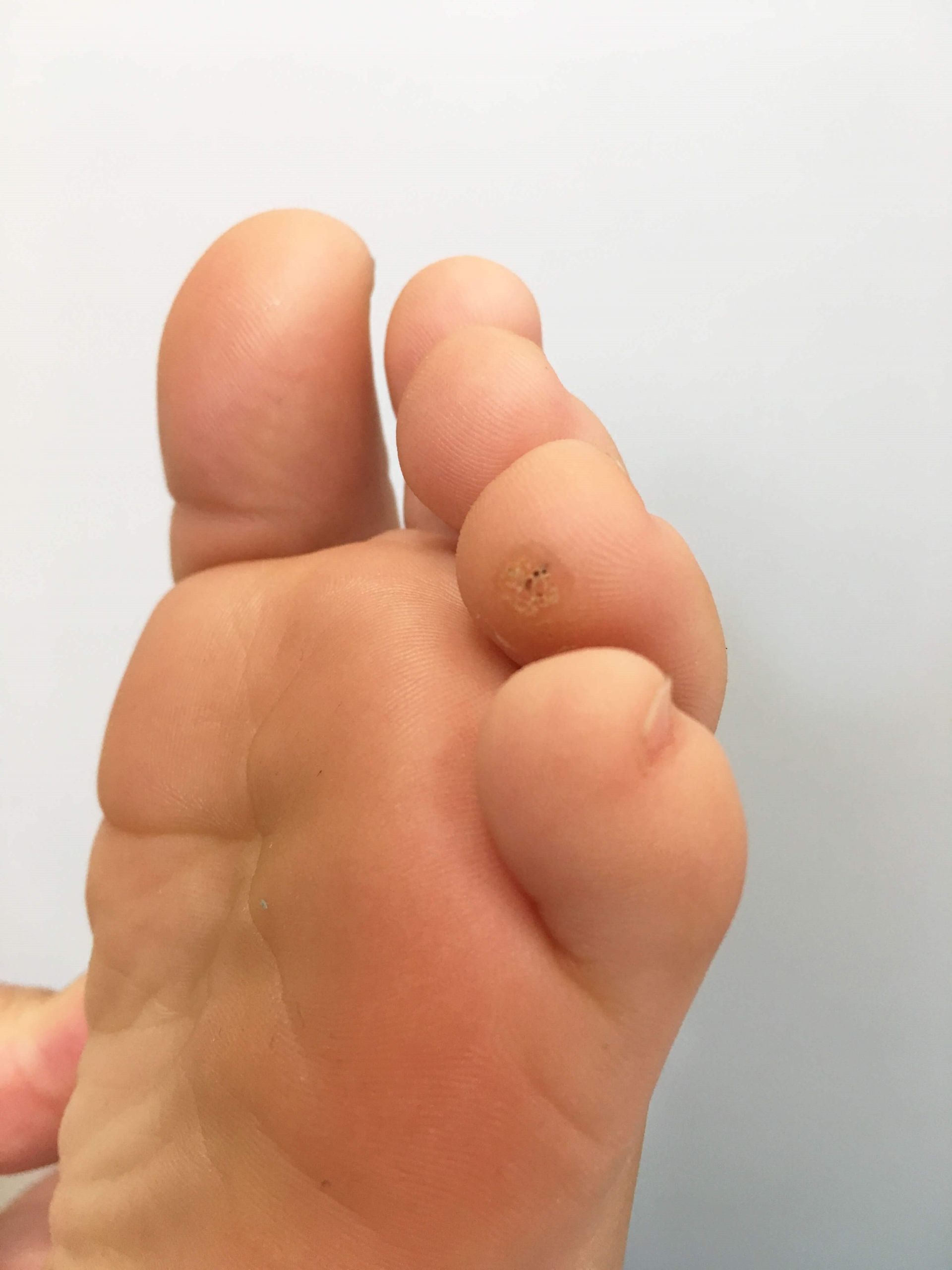 A close-up of a human foot showing a small, raised lesion with a central dark spot on the pad of the third toe.