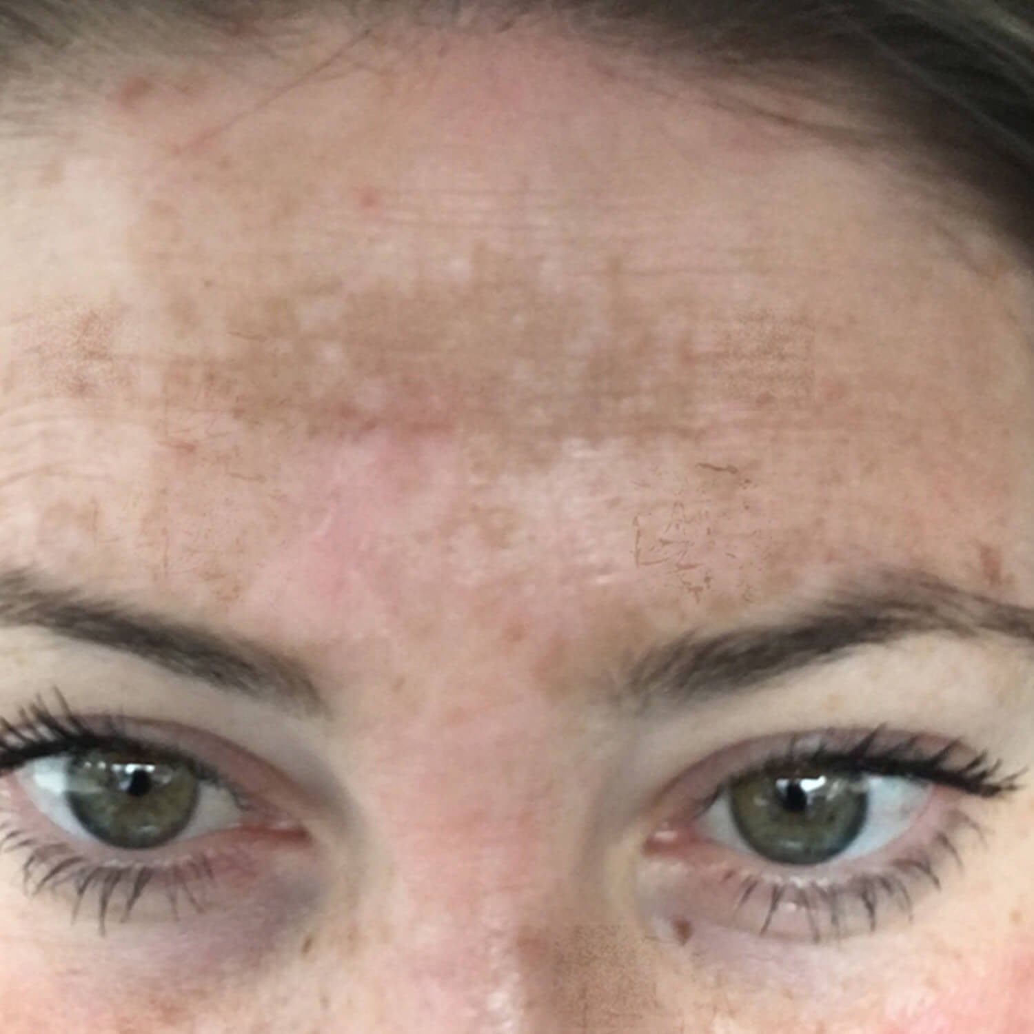 Close-up of a person's forehead showing patchy, brown hyperpigmentation across the brow and above the eyebrows.