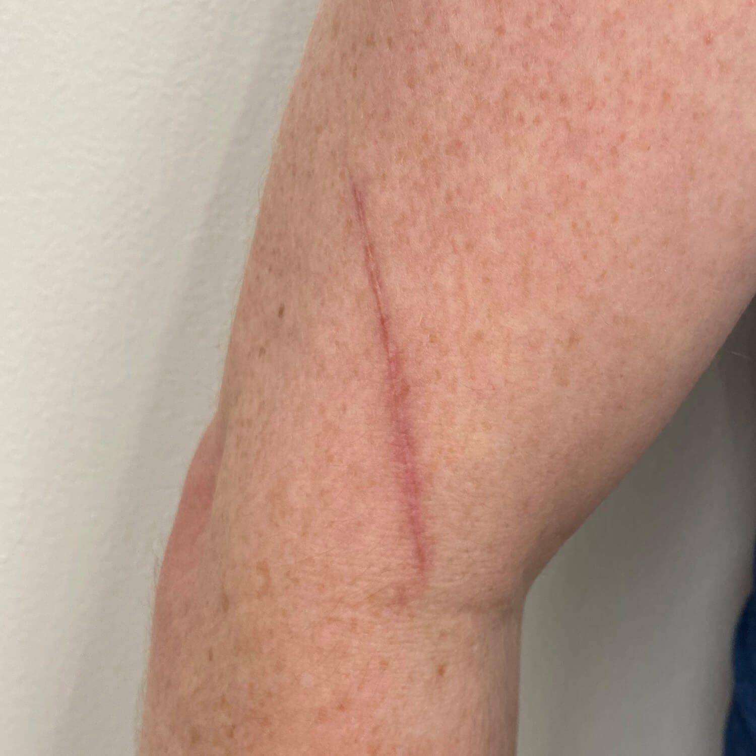A light-skinned arm with a reddish, vertical linear scar along the bicep against a plain background.