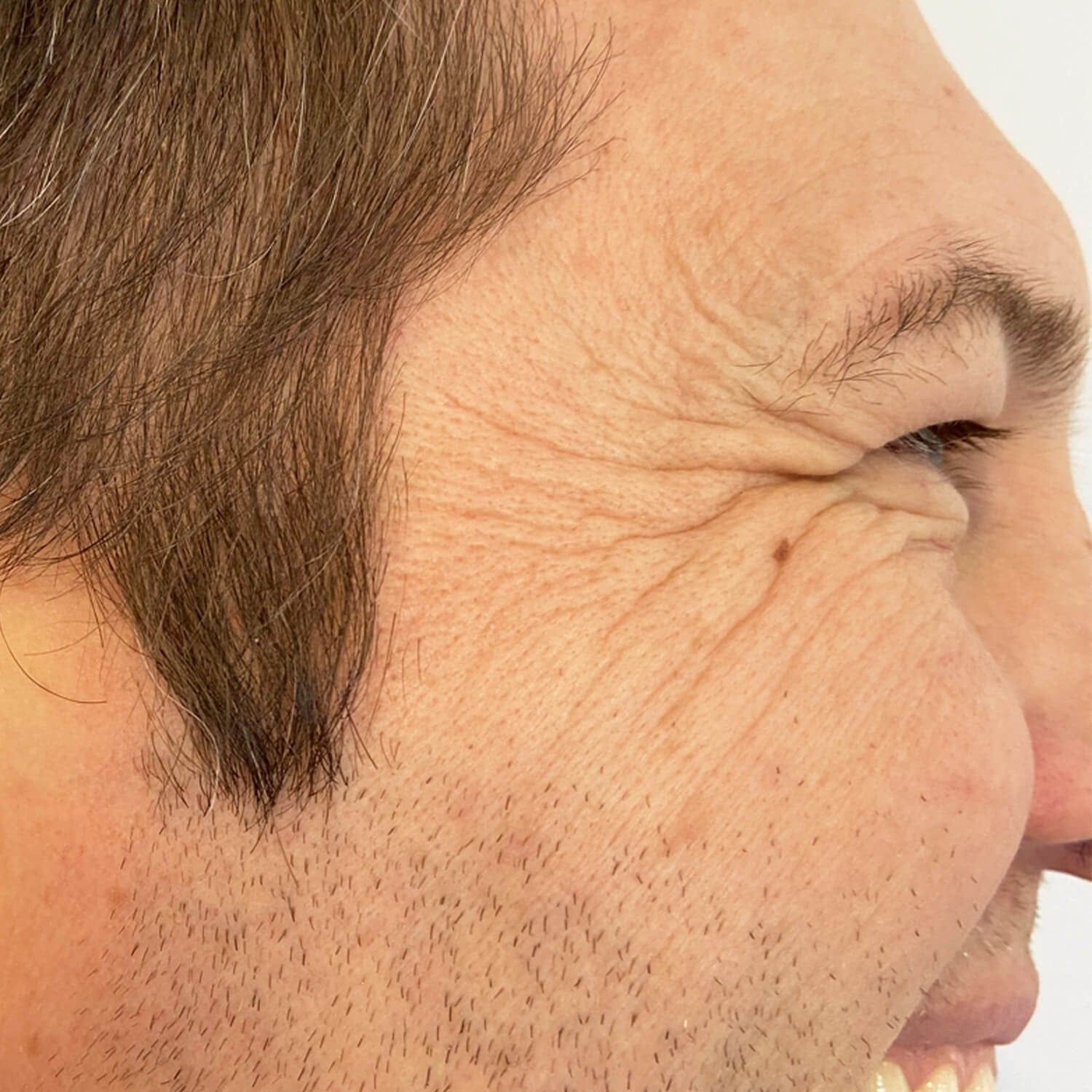 A close-up view of a person's eye area showing prominent crow's feet wrinkles while squinting.